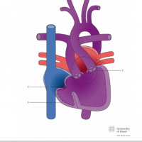 Double outlet left ventricle (DOLV) with ventricular septal defect (VSD)