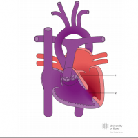 Double outlet right ventricle (DORV) with remote ventricular septal defect (VSD)
