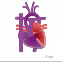 Double outlet right ventricle (DORV) with subaortal ventricular septal defect (VSD)