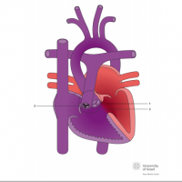 Double outlet right ventricle (DORV) with subaortic ventricular septal defect (VSD) and pulmonary stenosis
