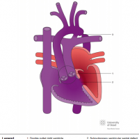 Double outlet right ventricle (DORV) with subpulmonary VSD (Taussig Bing) and aortic coarctation
