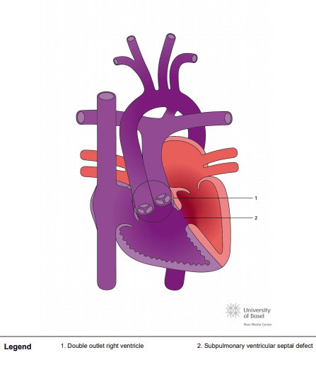 Double outlet right ventricle (DORV) with subpulmonary ventricular septal defect (Taussig Bing)