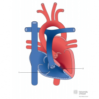 Doubled chambered right ventricle
