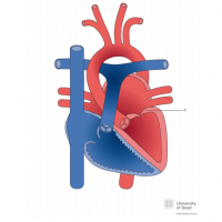 Dysplastic mitral valve with mitral stenosis