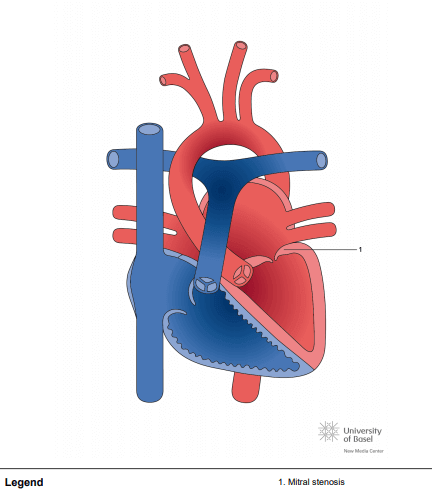 Dysplastic mitral valve with mitral stenosis
