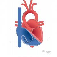 Ebstein anomaly with atrial septal defect (ASD II)