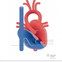 Ebstein anomaly with ventricular septal defect (VSD)