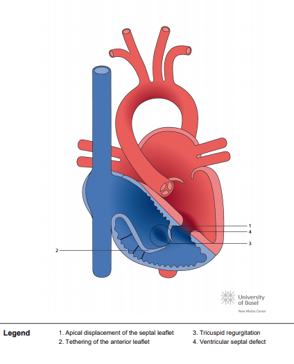 Ebstein anomaly with ventricular septal defect (VSD)
