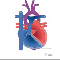 Eisenmenger syndrome with aorto-pulmonary window