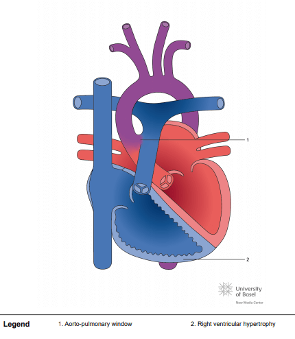 Eisenmenger syndrome with aorto-pulmonary window