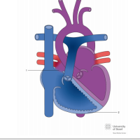 Eisenmenger syndrome with atrial septal defect (ASD)
