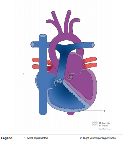 Eisenmenger syndrome with atrial septal defect (ASD)