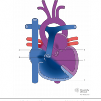 Eisenmenger syndrome with atrioventricular septal defect (AVSD)