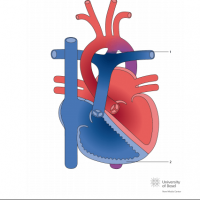 Eisenmenger syndrome with patent ductus arteriosus (PDA)