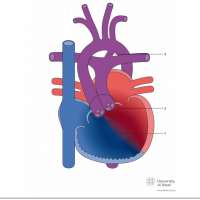 Eisenmenger syndrome with single ventricular physiology