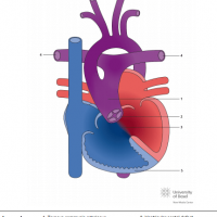 Eisenmenger syndrome with truncus arteriosus communis