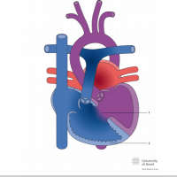 Eisenmenger syndrome with ventricular septal defect (VSD)