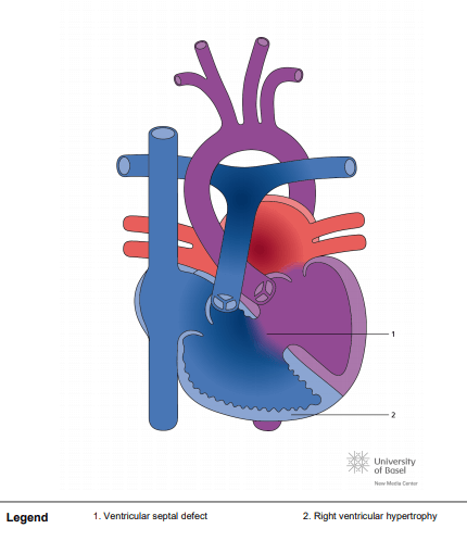 Eisenmenger syndrome with ventricular septal defect (VSD)