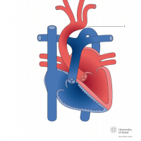 Interrupted aortic arch Type I
