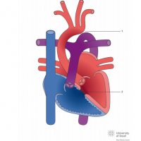 Interrupted aortic arch Type I with ventricular septal defect (VSD)