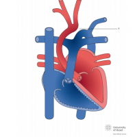Interrupted aortic arch Type II