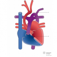 Interrupted aortic arch Type II with ventricular septal defect (VSD)