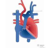 Interrupted aortic arch Type III