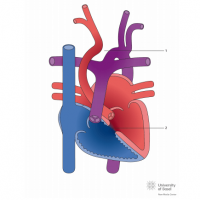 Interrupted aortic arch Type III with ventricular septal defect (VSD)