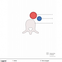 Left atrial isomerism; short axis of aorta and inferior caval vein