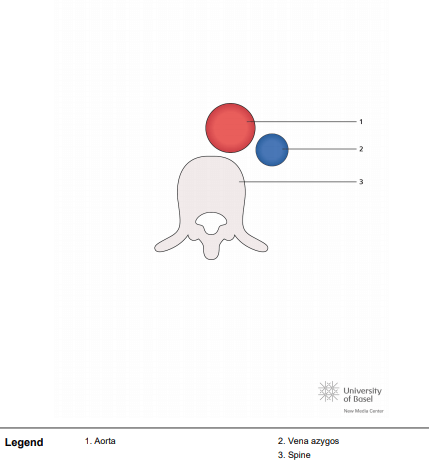 Left atrial isomerism; short axis of aorta and inferior caval vein