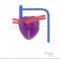 Left atrial isomerism, total anomalous pulmonary venous connection (TAPVC) and atrioventricular septal defect