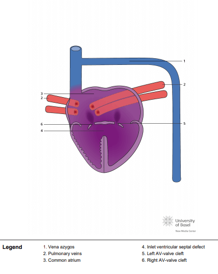 Left atrial isomerism, total anomalous pulmonary venous connection (TAPVC) and atrioventricular septal defect