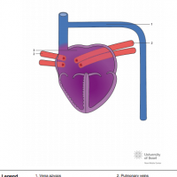 Left atrial isomerism, vena azygos and total anomalous pulmonary venous connection (TAPVC)
