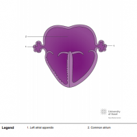 Left atrial isomerism with common atrium