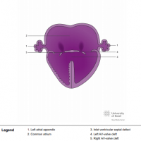 Left atrial isomerism with common atrium and atrioventricular septal defect (AVSD)