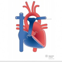 Left pulmonary artery (LPA) stenosis