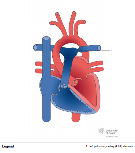 Left pulmonary artery (LPA) stenosis