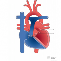 Marfan syndrome