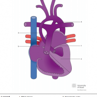 Mitral atresia and hypoplastic left ventricle