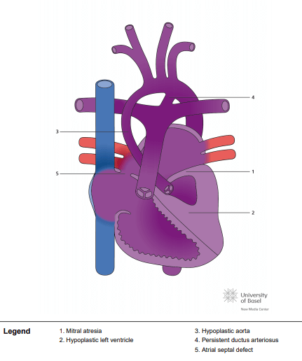 Mitral atresia and hypoplastic left ventricle
