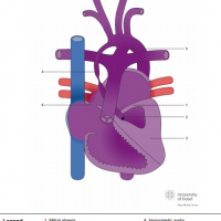 Mitral atresia, aortic atresia, hypoplastic left ventricle and interrupted ascending aorta