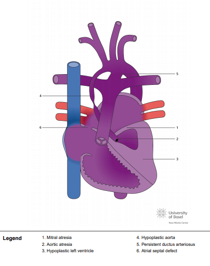 Mitral atresia, aortic atresia, hypoplastic left ventricle and interrupted ascending aorta