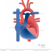 Noonan syndrome