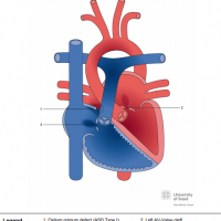 Partial atrioventricular septal defect (ASD Type I, Ostium primum defect)