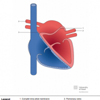 Partial cor triatriatum sinister with complete membrane