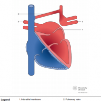 Partial cor triatriatum sinister with partial pulmonary vein connection