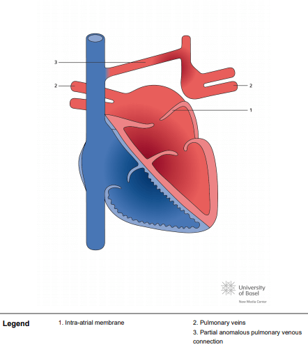 Partial cor triatriatum sinister with partial pulmonary vein connection