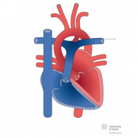 Patent ductus arteriosus (PDA)