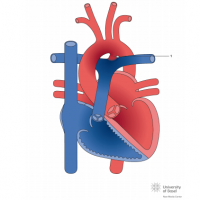 Patent ductus arteriosus (PDA) with left ventricular dilatation