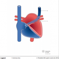 Persistent left superior caval vein